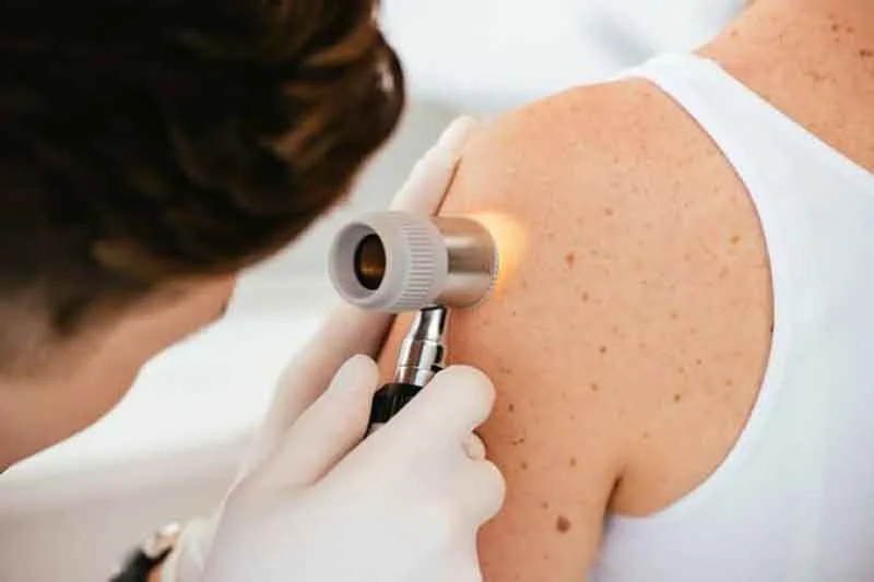Cáncer de piel: señales que no debes ignorar Dermatologia Cancer de Piel