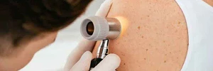 Dermatologia Cancer de Piel